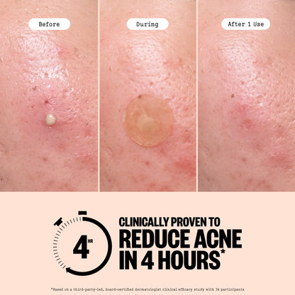 Acne Treatment Dots